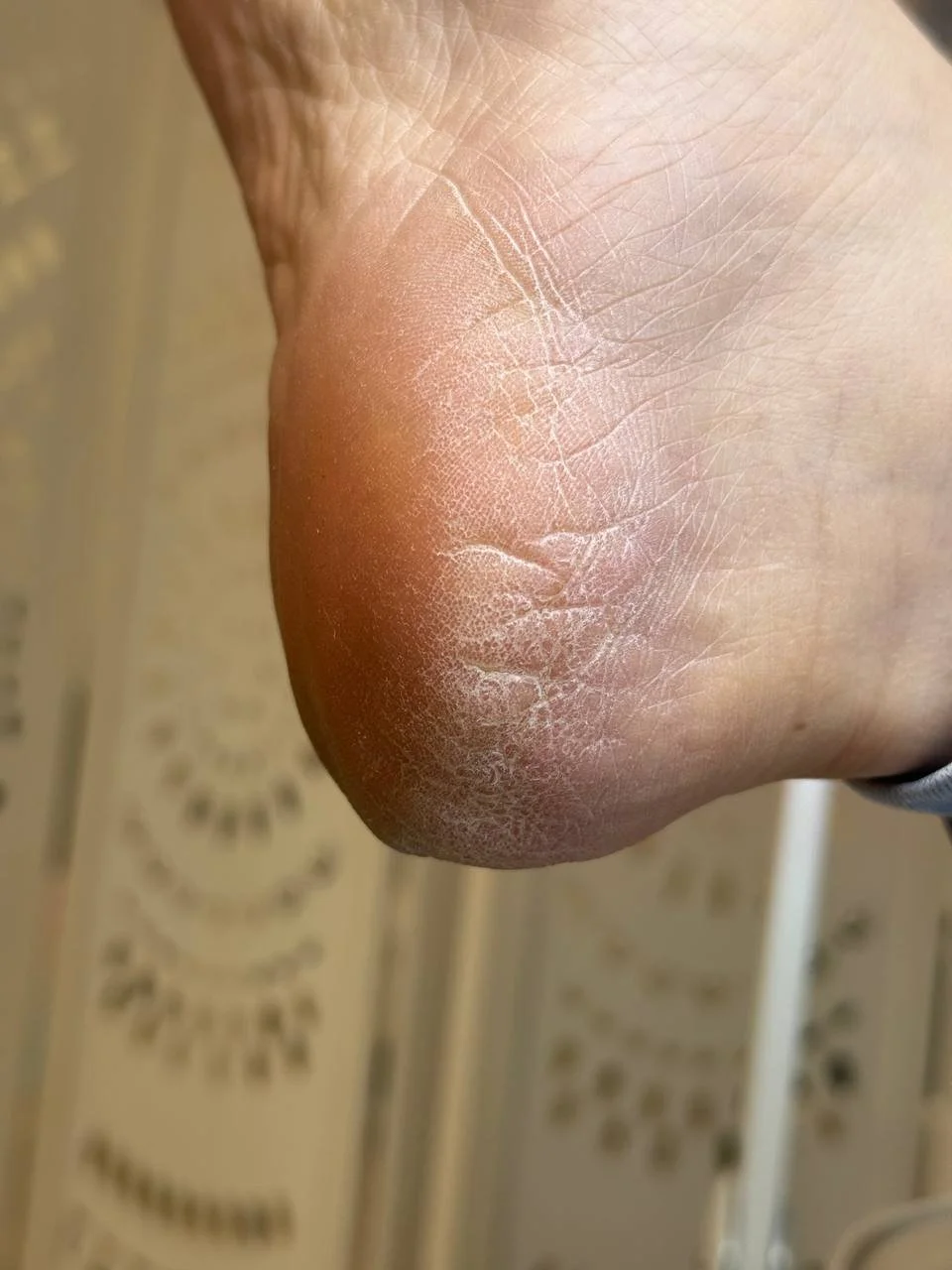Dry cracked heel before foot care