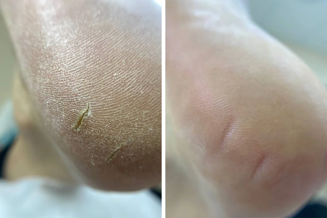 Before treatment — cracked heels NYC pedicure
