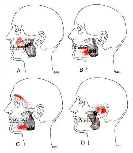 Masseter trigger point referral pattern