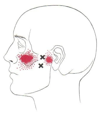 Lateral pterygoid trigger point referral pattern, view 2