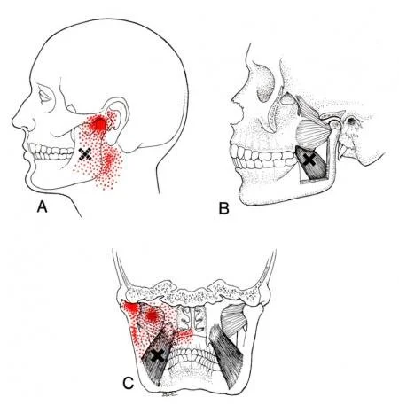 Medial pterygoid trigger point referral pattern