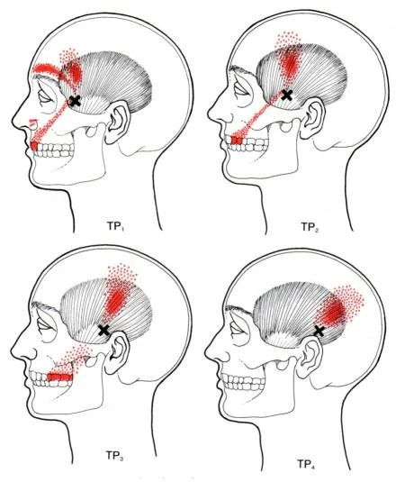 Temporalis trigger point referral pattern