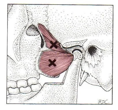 Lateral pterygoid trigger point referral pattern, view 1