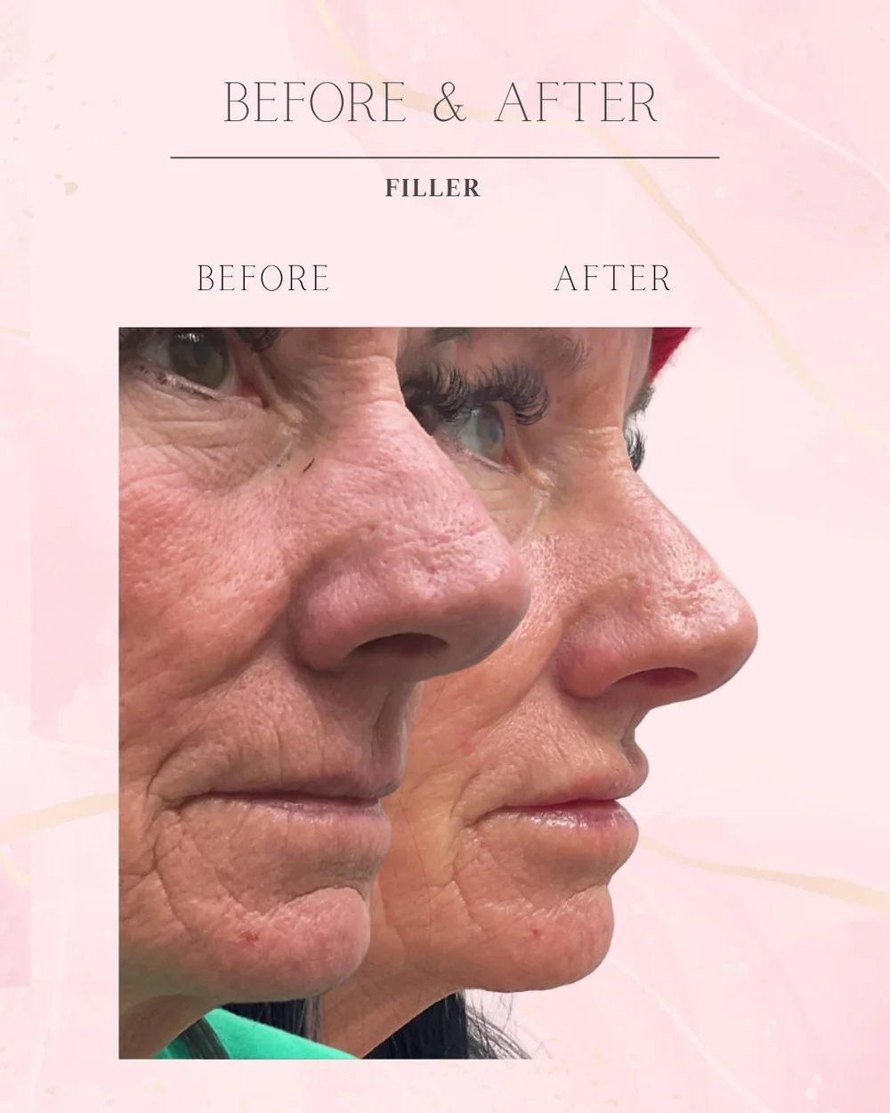Lip filler before and after side profile, softer lip lines on mature skin, Skin Affaire MedSpa