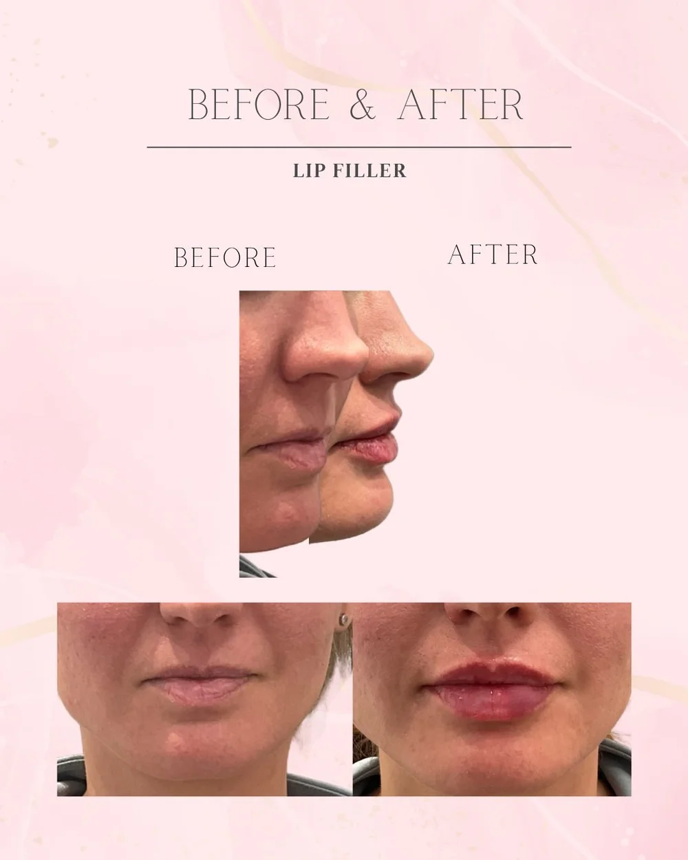 Lip filler before and after, front and side profile, Skin Affaire MedSpa Excelsior Springs
