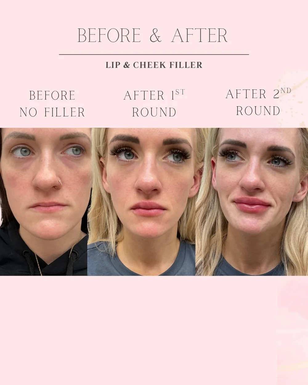 Lip and cheek filler before, after first visit and after second visit, front view, Skin Affaire MedSpa Excelsior Springs MO