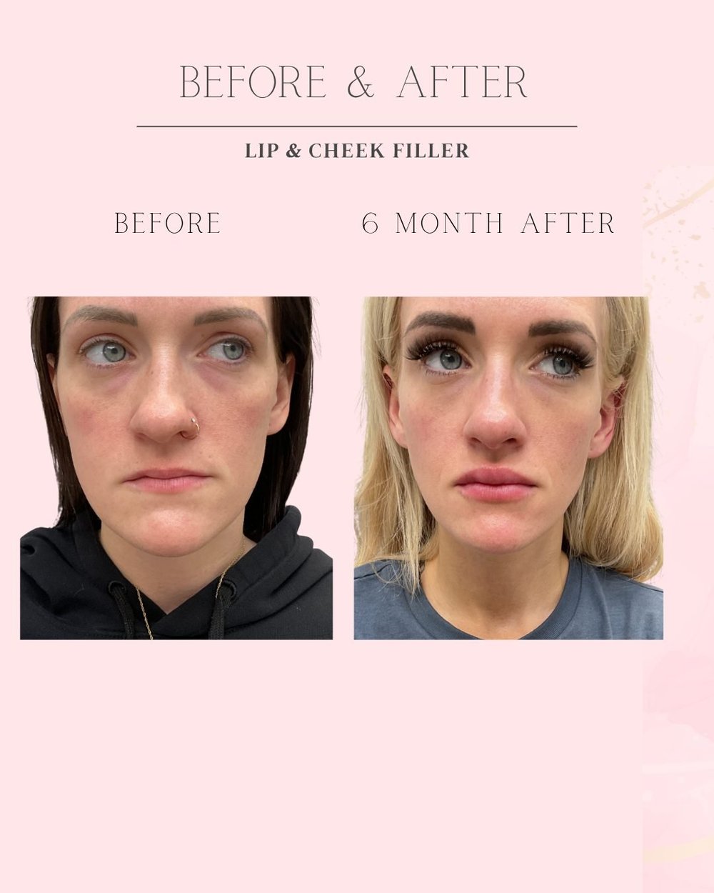 Lip and cheek filler before and 6 months after, front view, Skin Affaire MedSpa