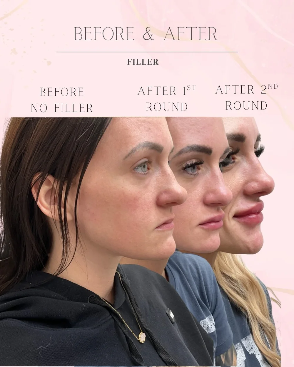 Lip and cheek filler side profile over three visits showing gradual lip volume, Excelsior Springs MO