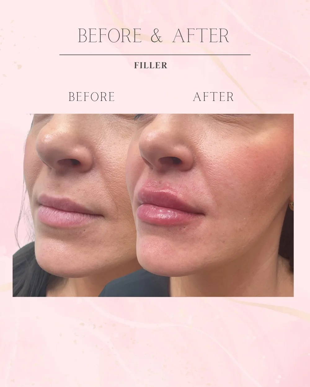 Lip filler before and after, angled view of fuller upper lip and defined border, Excelsior Springs MO