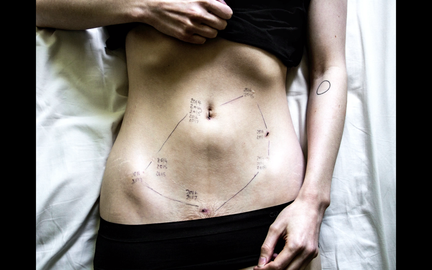 This is Endometriosis