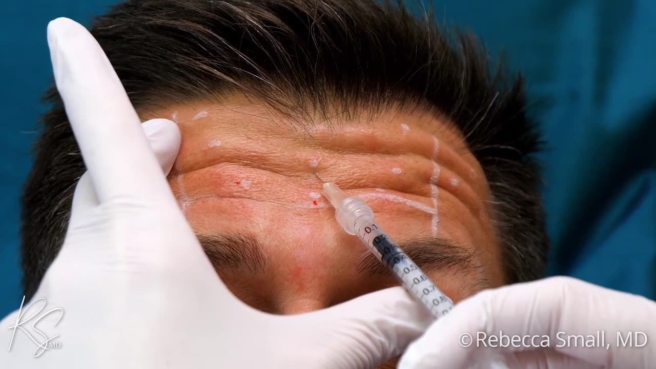 Forehead Lines Toxin