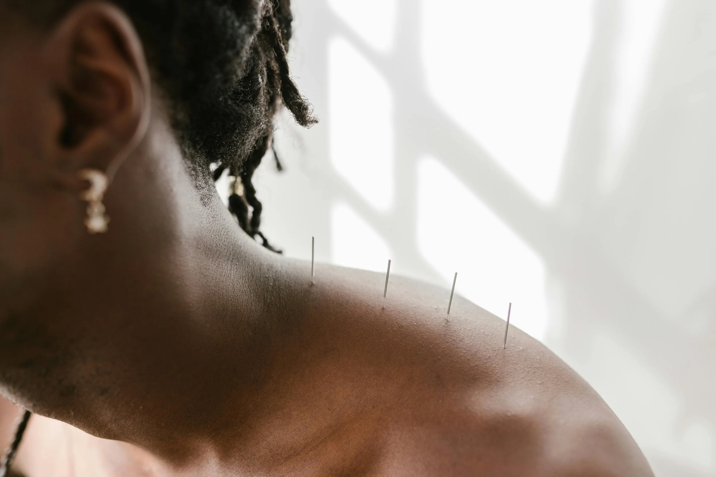 Woman receiving acupuncture for stress relief