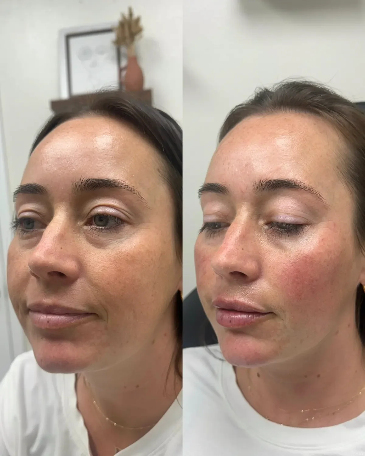 Facial balancing dermal filler before and after at Glowtox Aesthetics