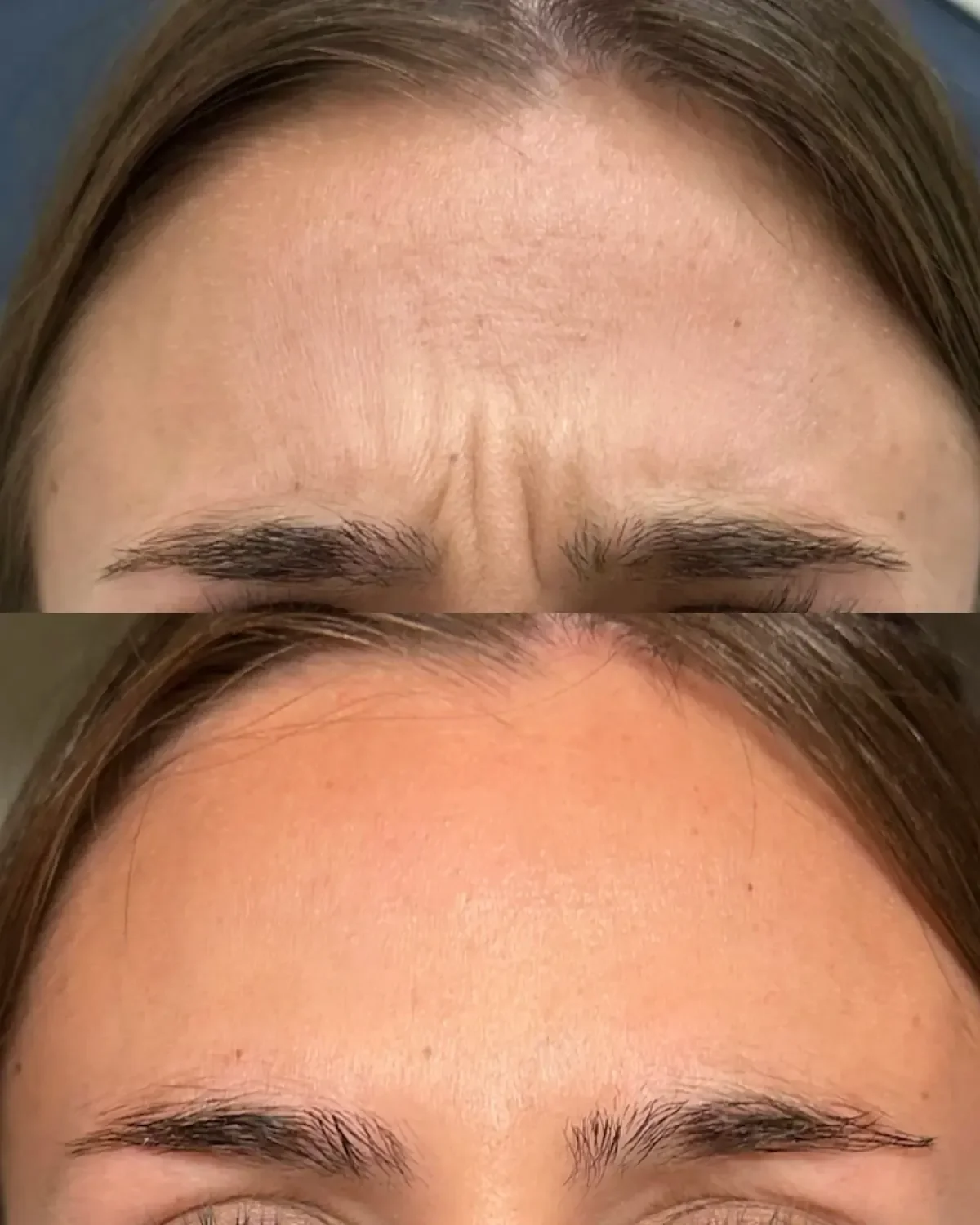 Forehead wrinkle Botox before and after at Glowtox Aesthetics San Diego