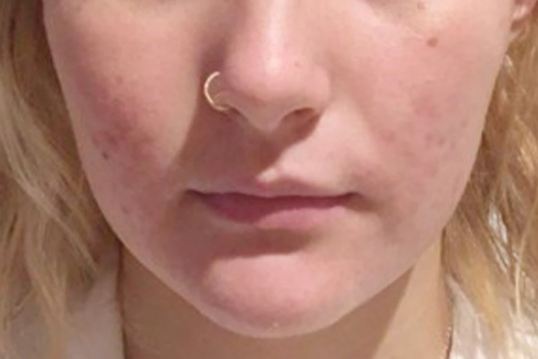 Acne scarring after Dermapen 4 microneedling (Dermapen clinical photo)
