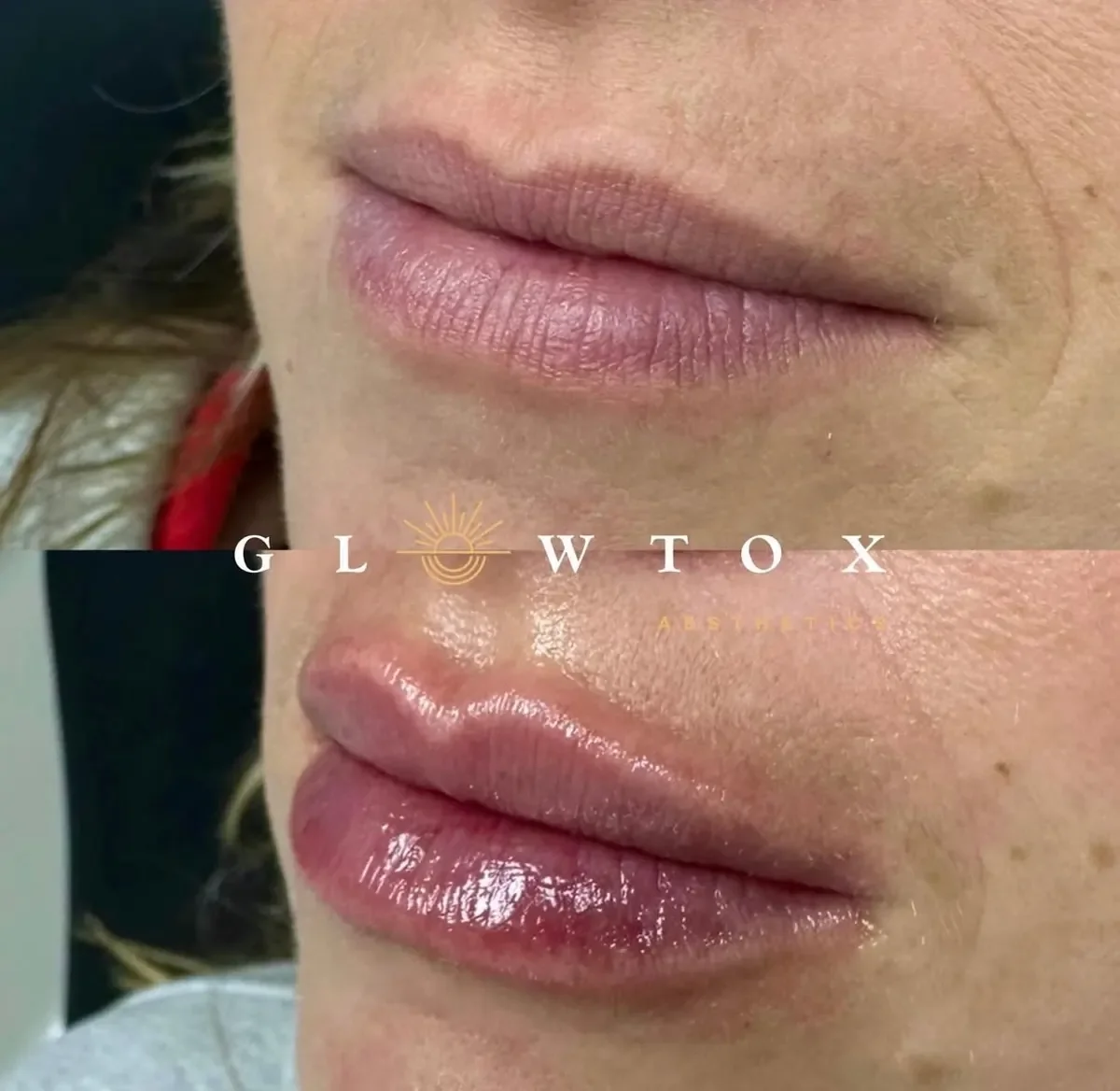 Lip filler before and after at Glowtox Aesthetics San Diego