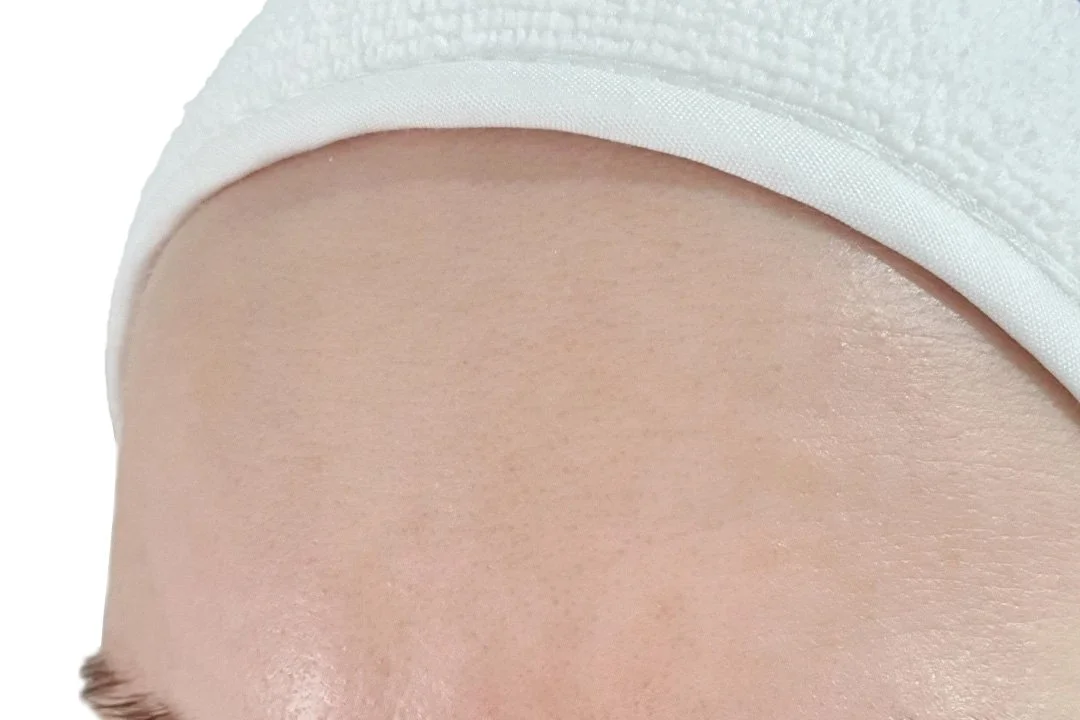 Forehead after Dermapen 4 microneedling (Dermapen clinical photo)