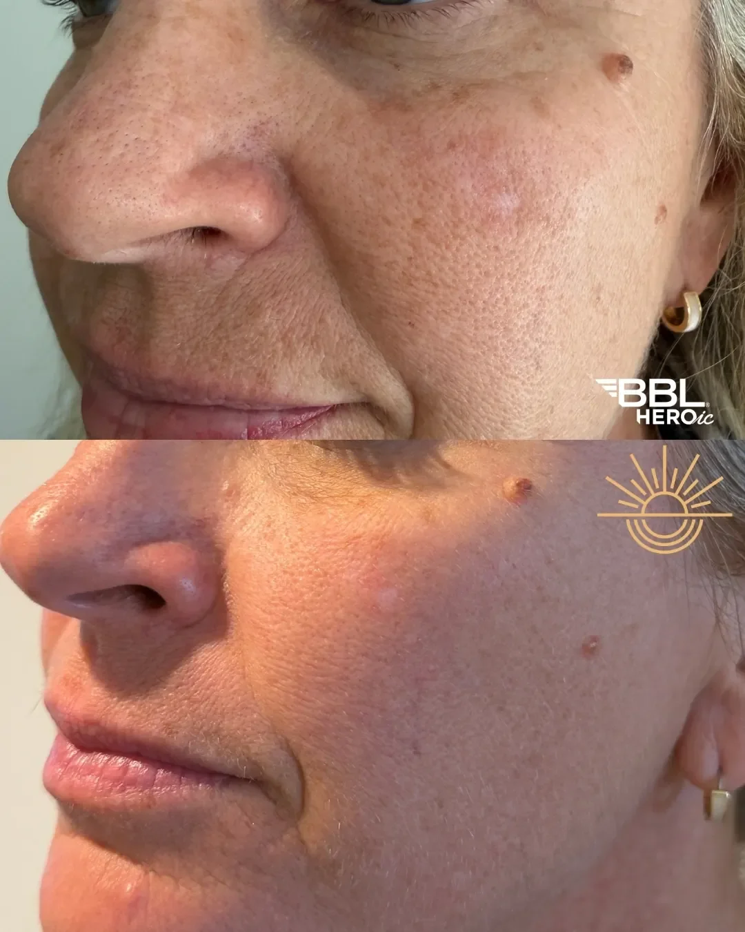 BBL HEROic before and after at Glowtox Aesthetics