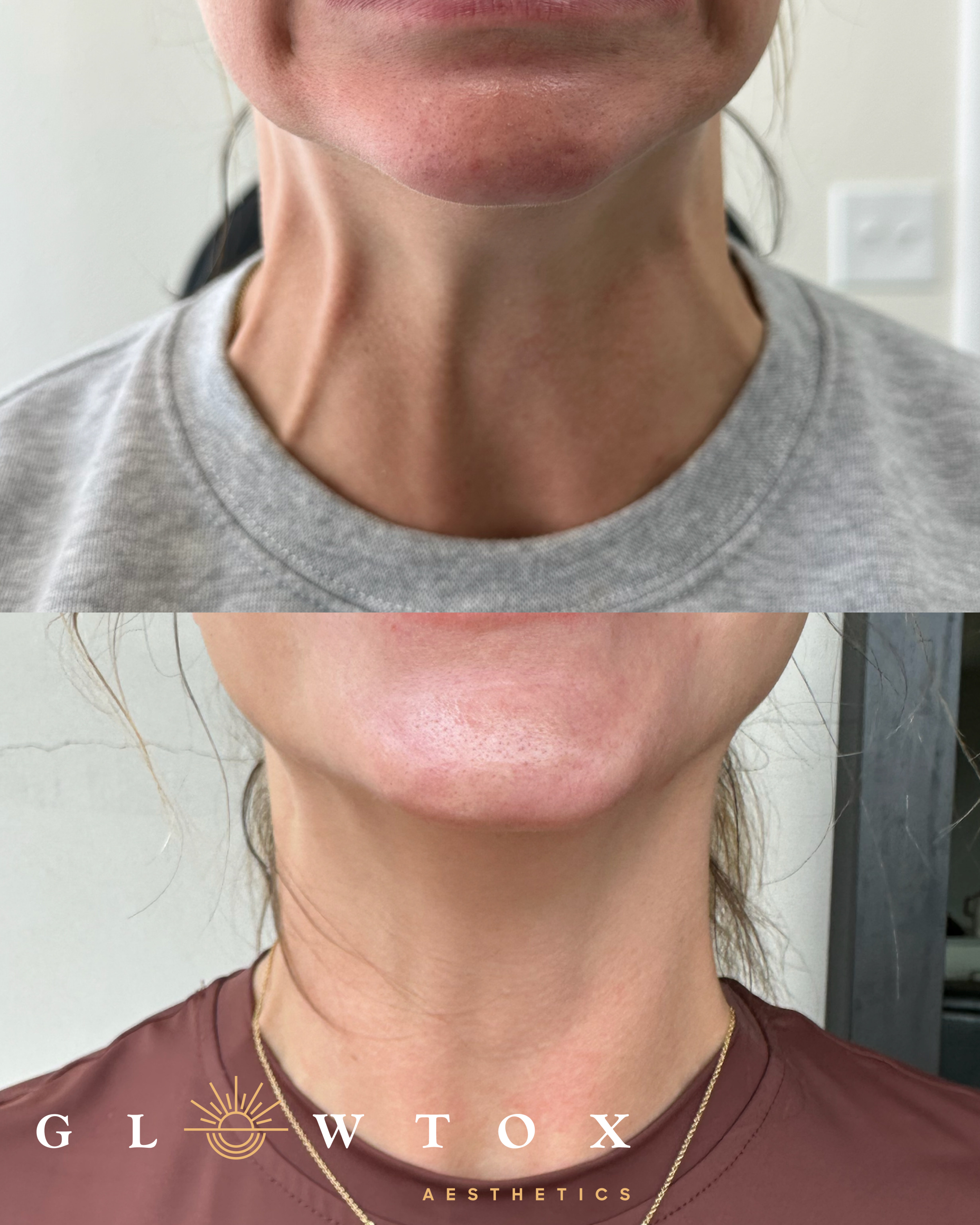 Platysmal band Botox before and after at Glowtox Aesthetics San Diego