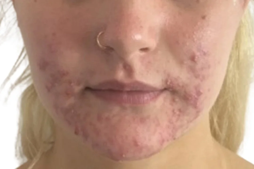 Acne scarring before Dermapen 4 microneedling (Dermapen clinical photo)