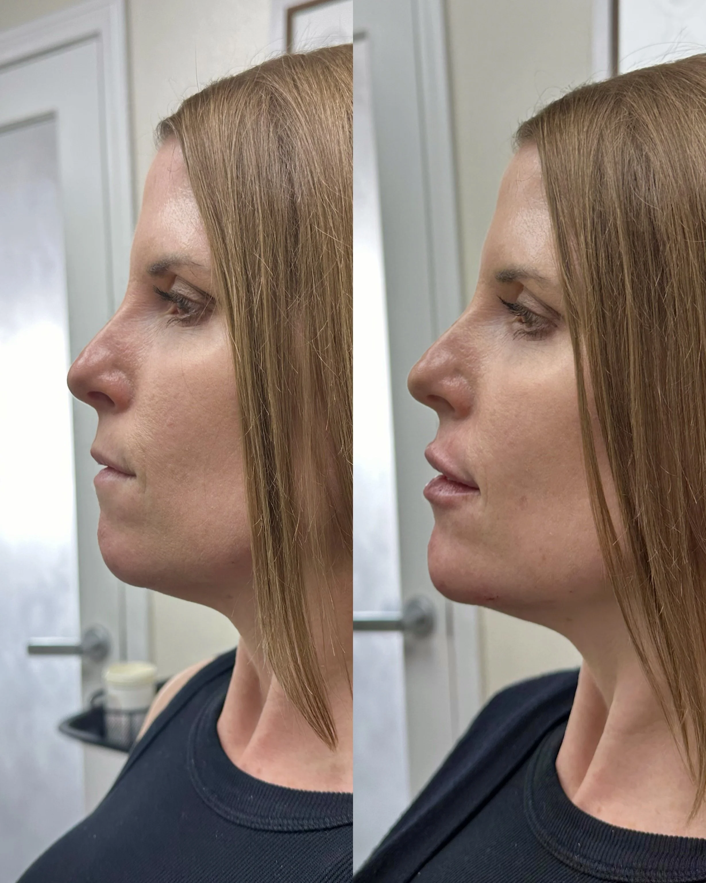 Dermal filler result at Glowtox Aesthetics in San Diego