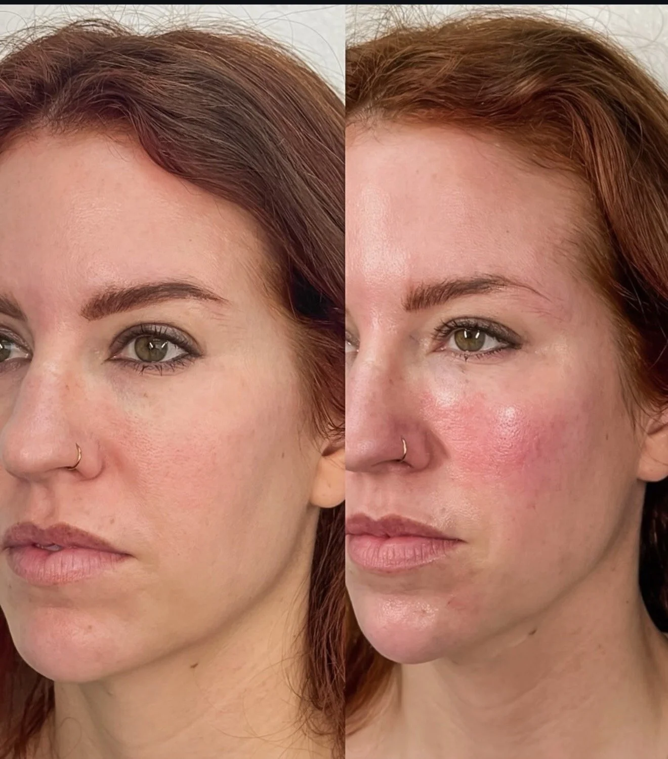 Face before and after PRP treatment at Glowtox Aesthetics