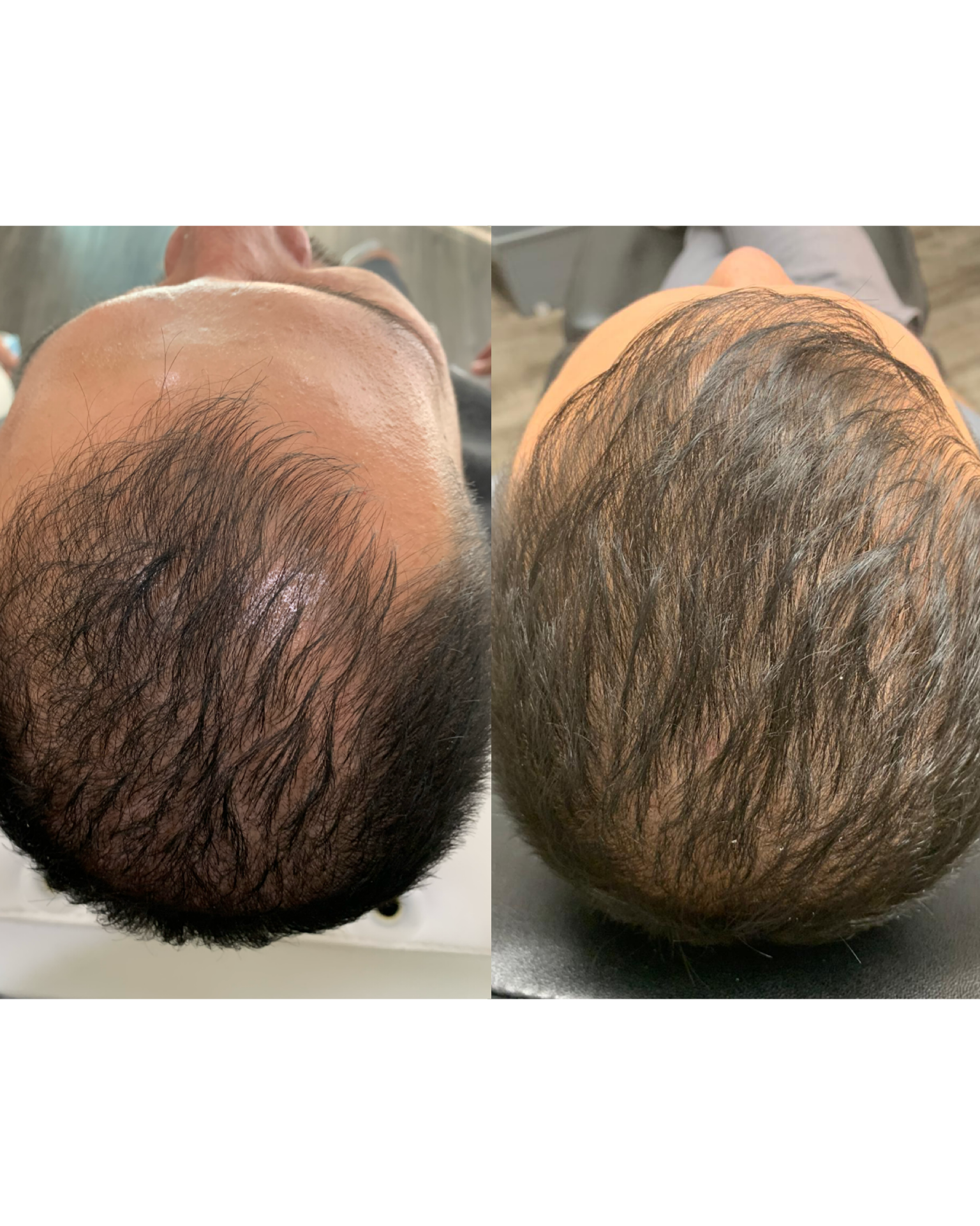 Scalp before and after PRP hair restoration at Glowtox Aesthetics
