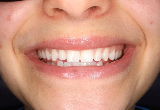 Invisalign Case A After