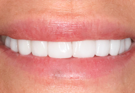 Veneer Case B After
