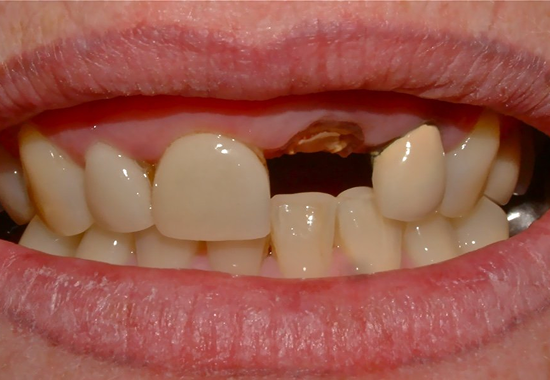 Single Tooth Implant Case A Before
