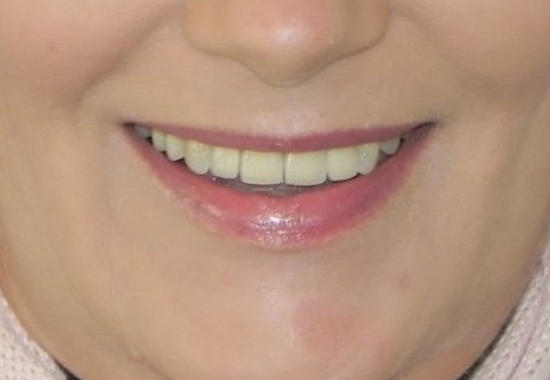 Multiple Implants Case A After