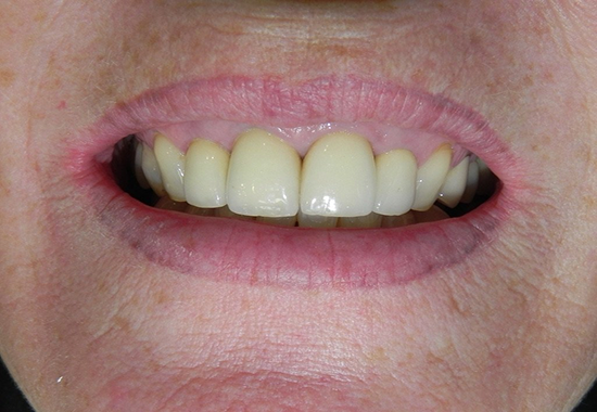 Single Tooth Implant Case A After