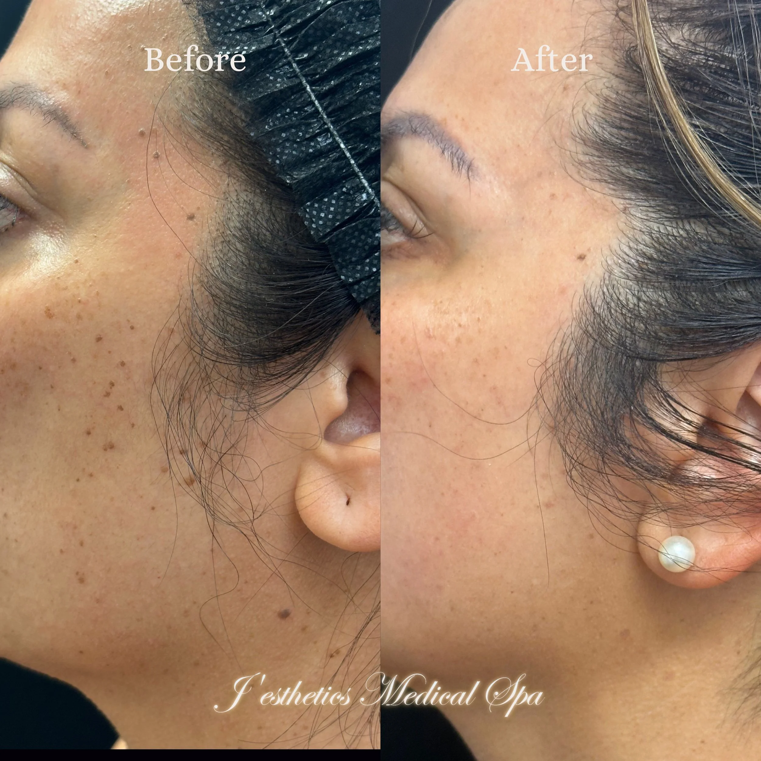 Rejuran Skin Booster After