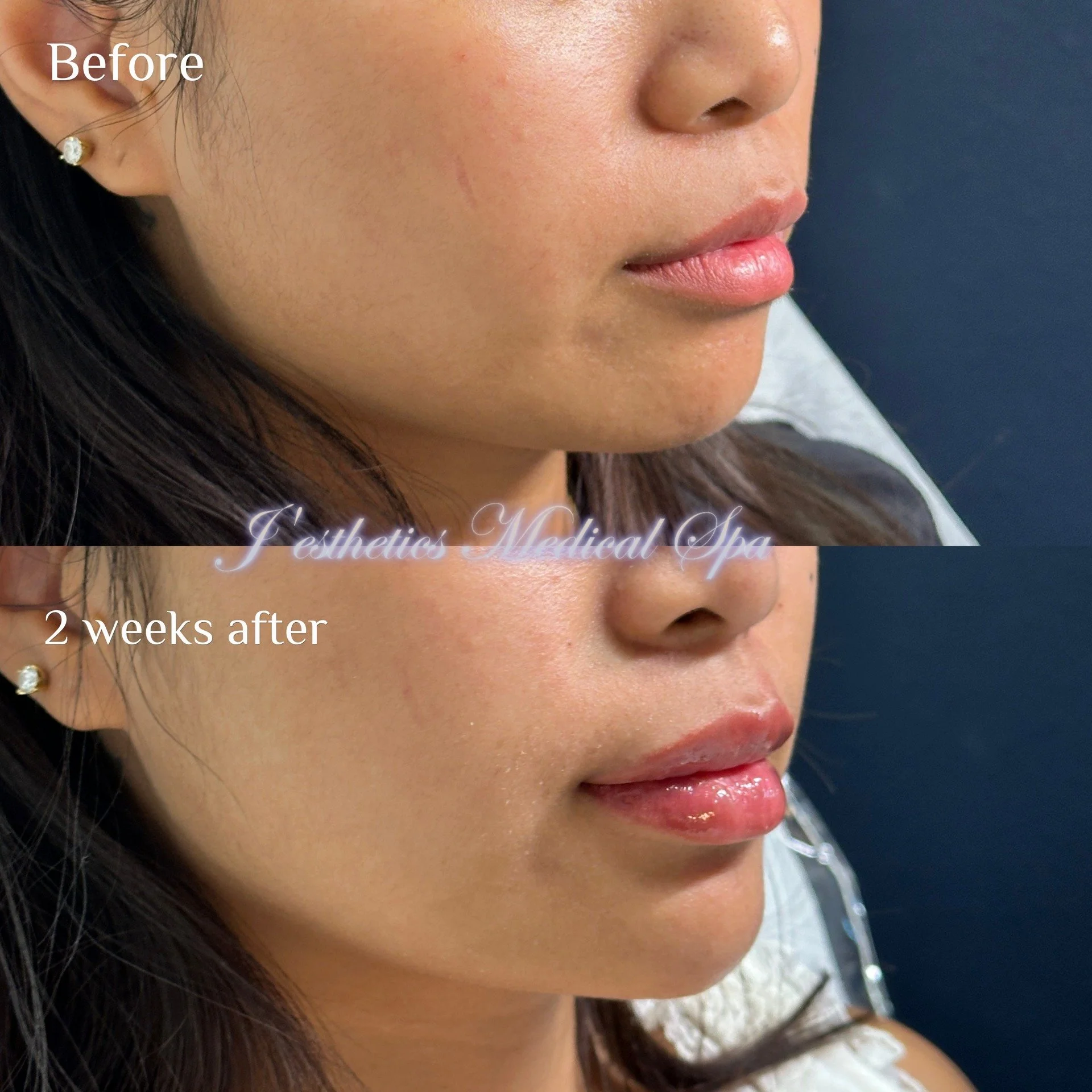 Face Balancing Filler After