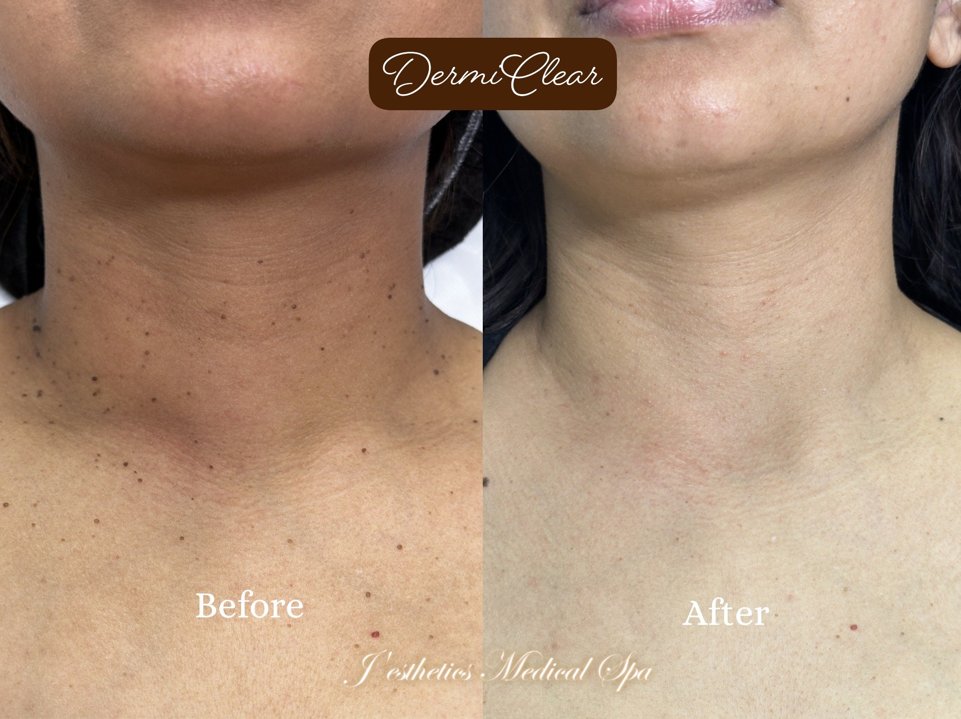 Rejuran Skin Booster Before