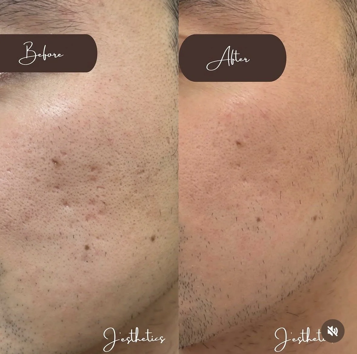 Microneedling Before