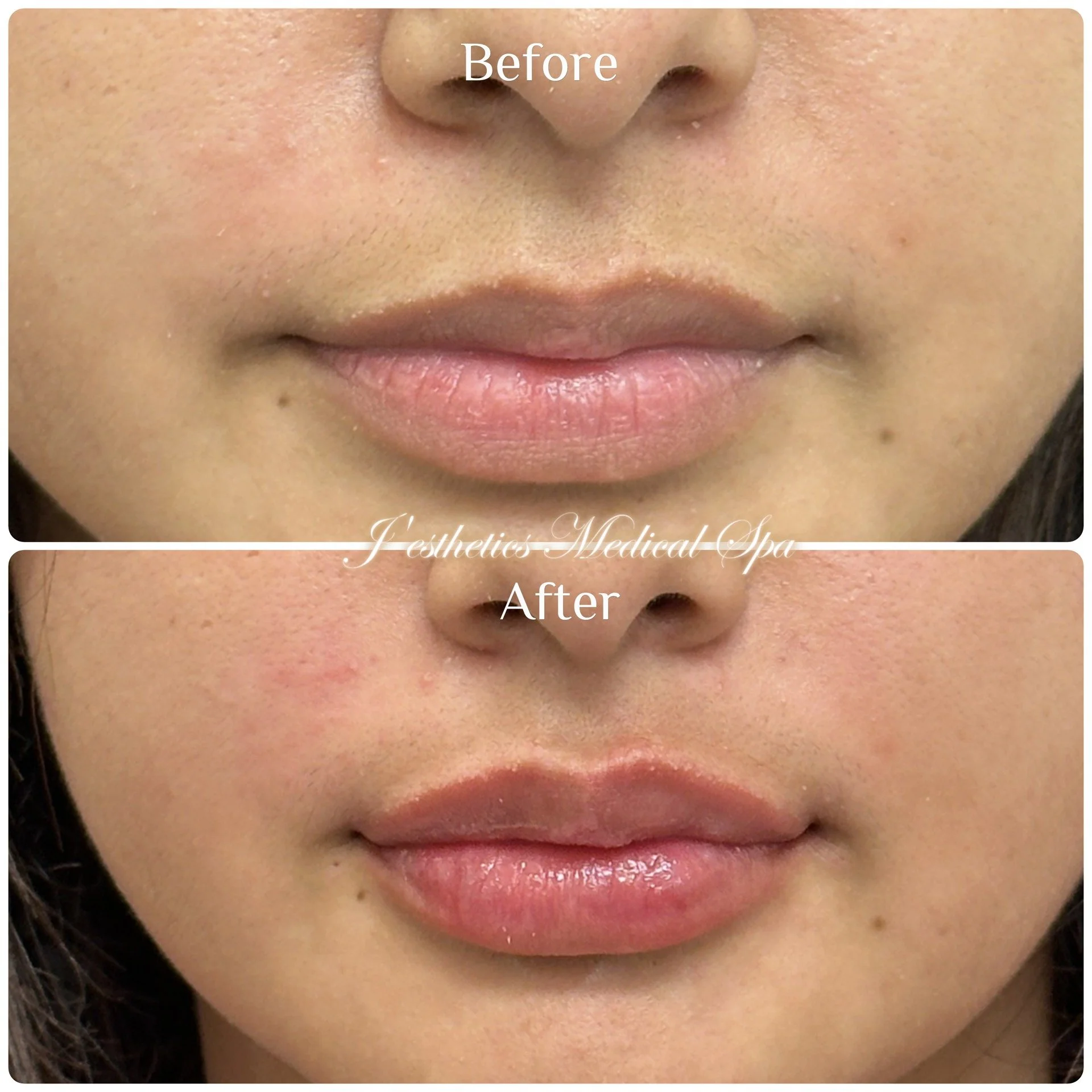 8D Lip Enhancement After