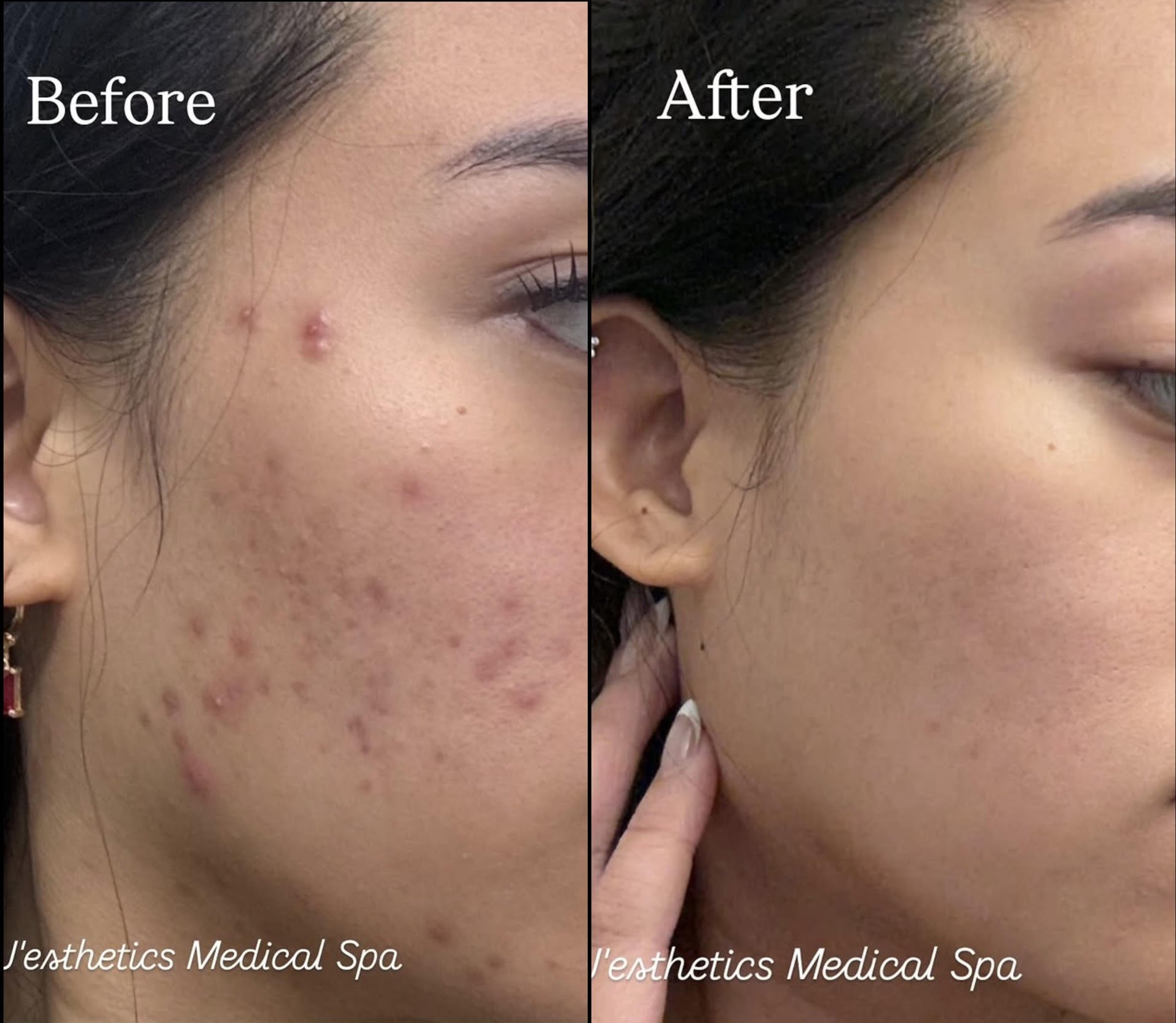 Chemical Peel Before