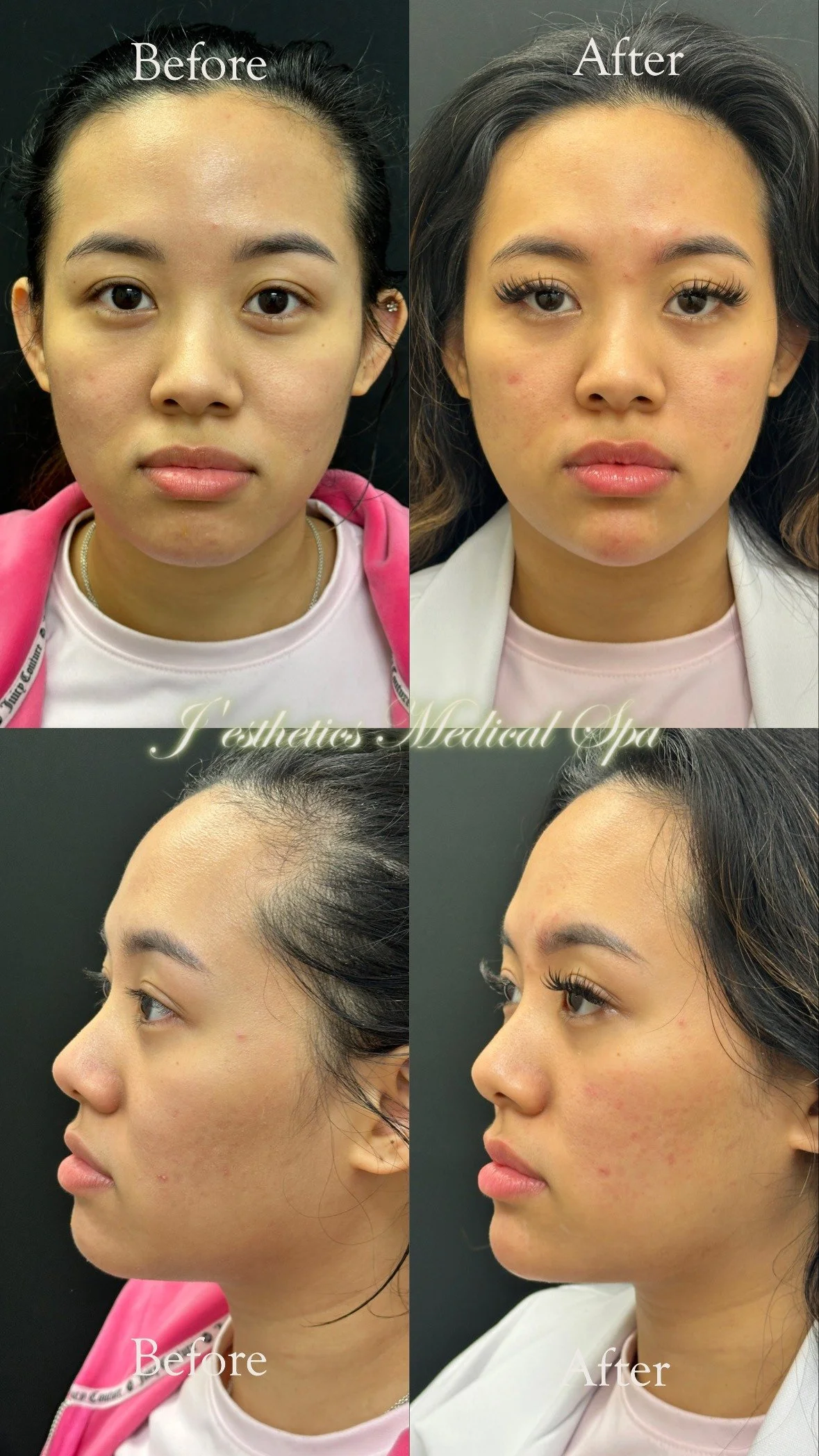 Face Balancing Filler Before