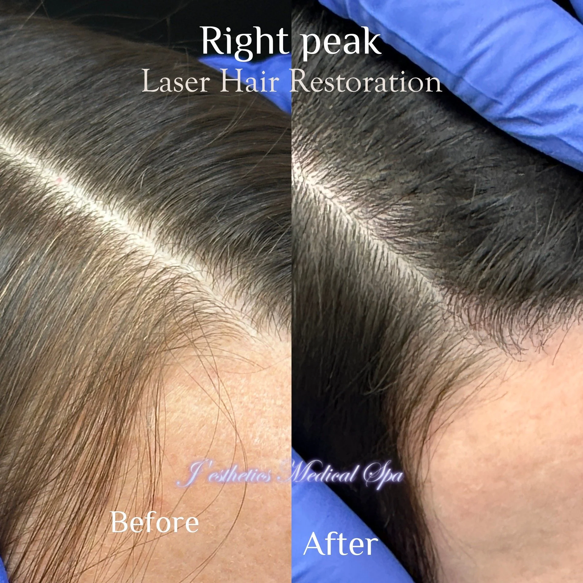 Laser Resurfacing Before