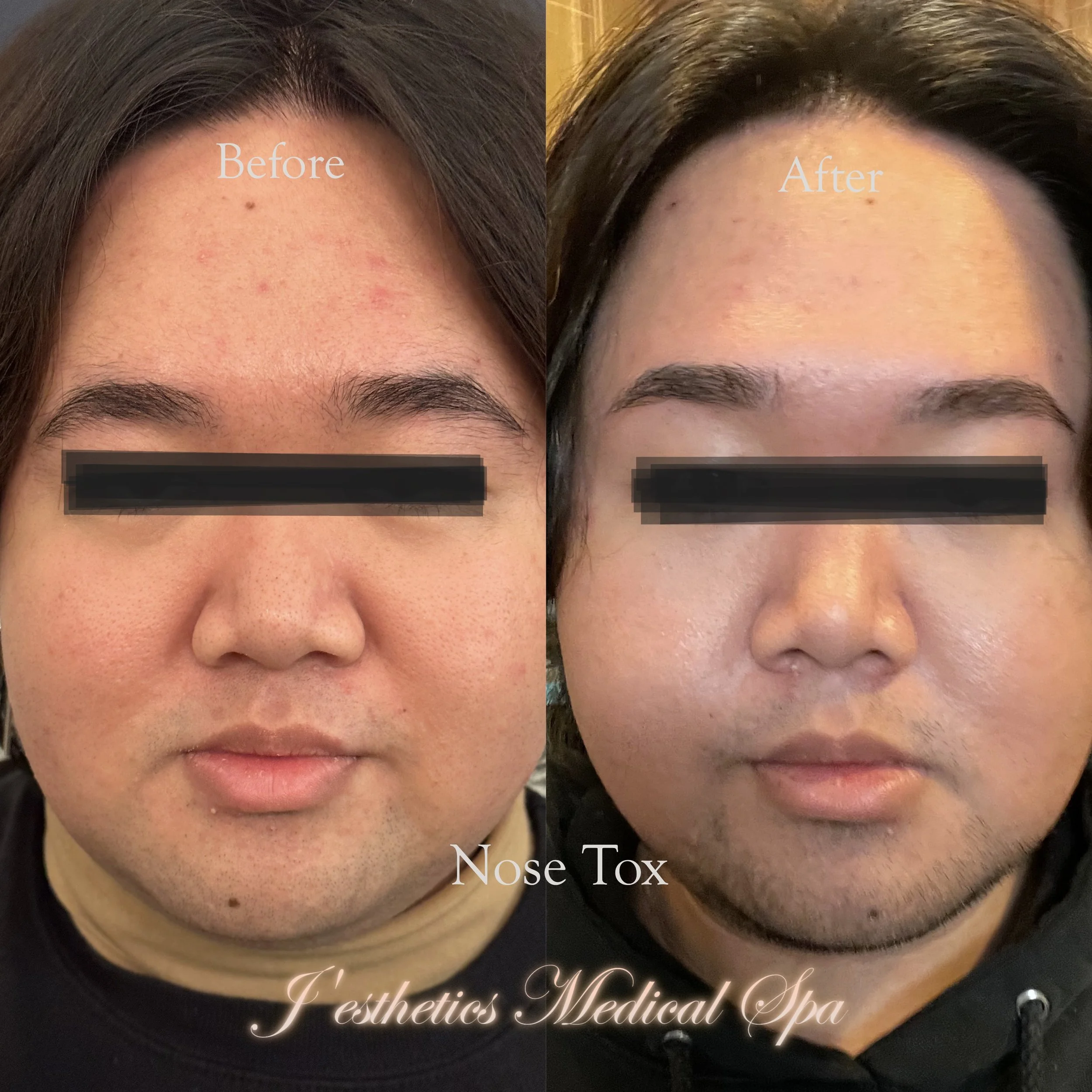 Botox Crow's Feet After