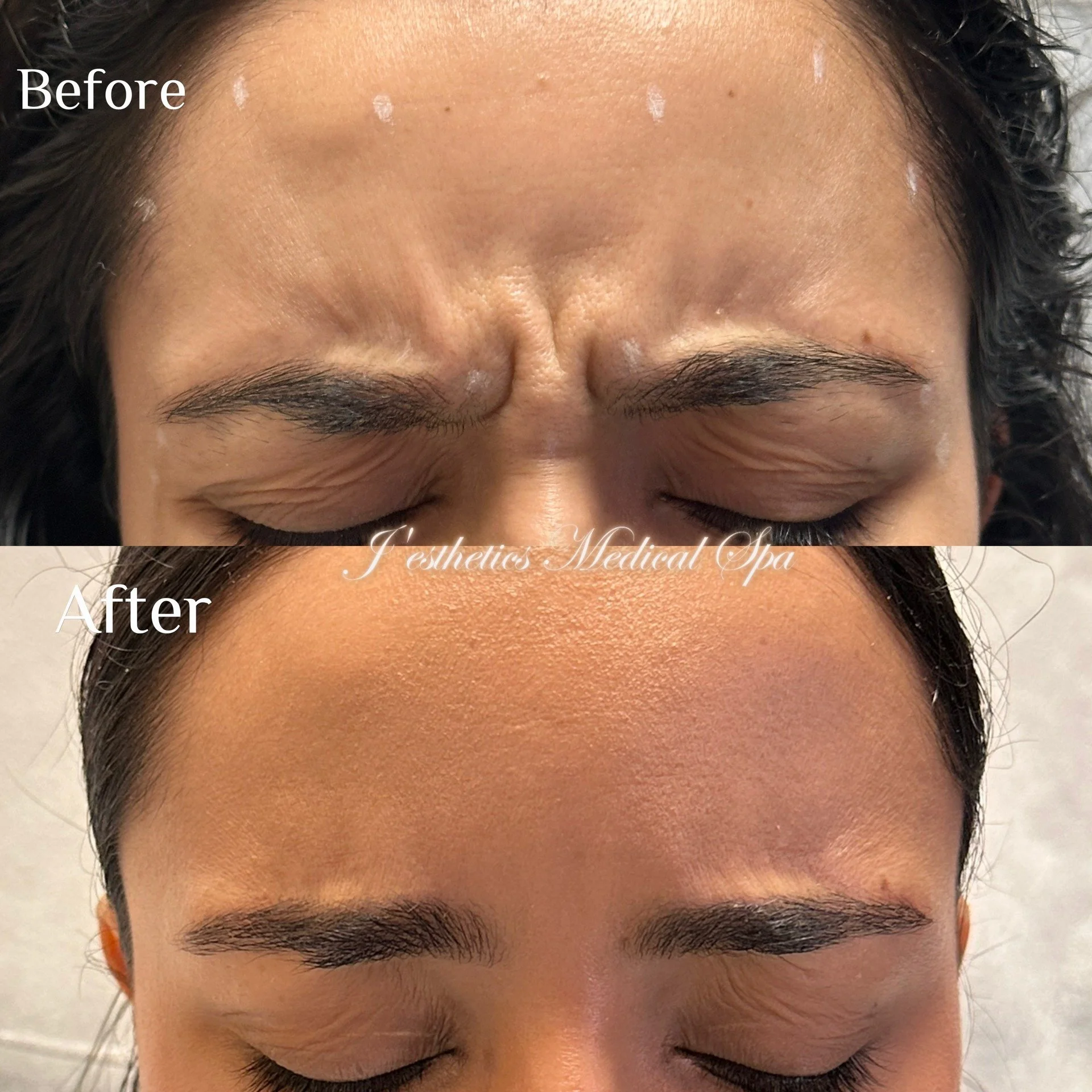 Botox Forehead Before