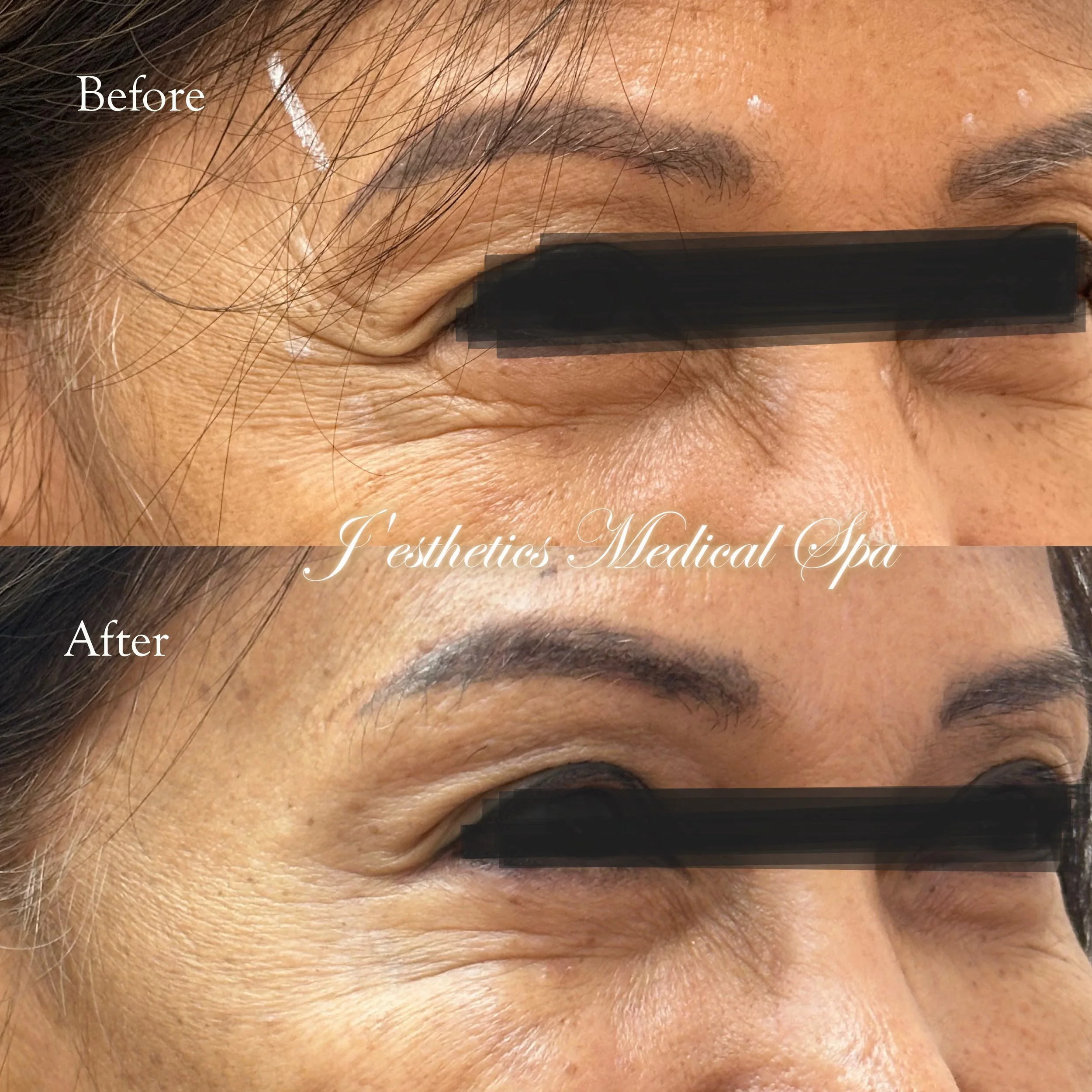 Botox Crow's Feet Before