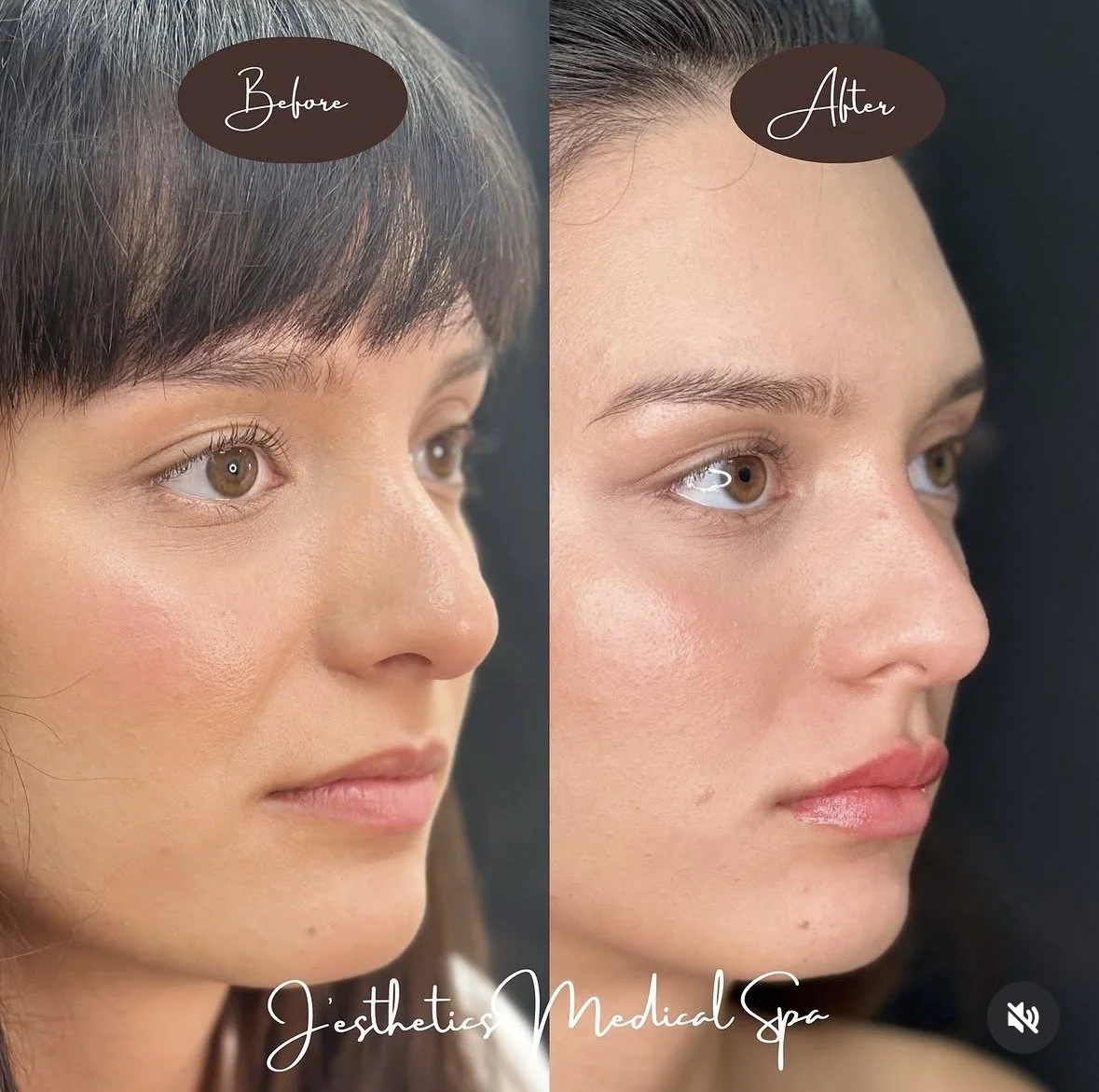 Lip Filler After