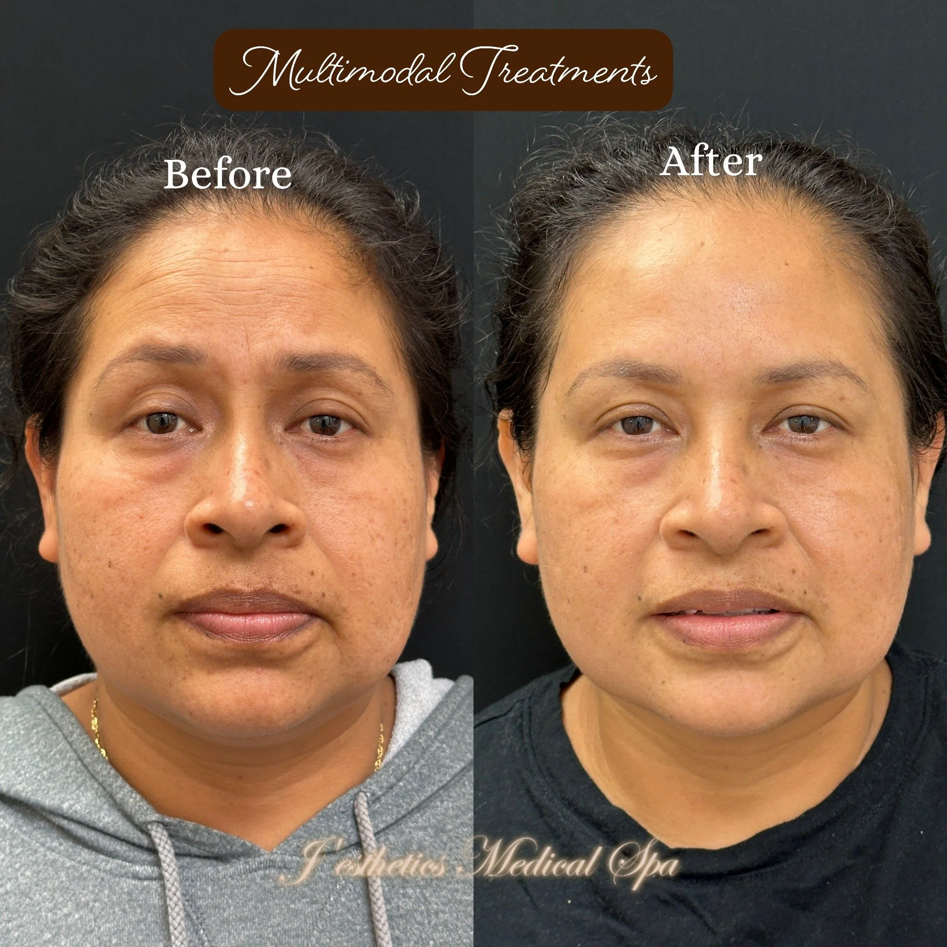 Microneedling After