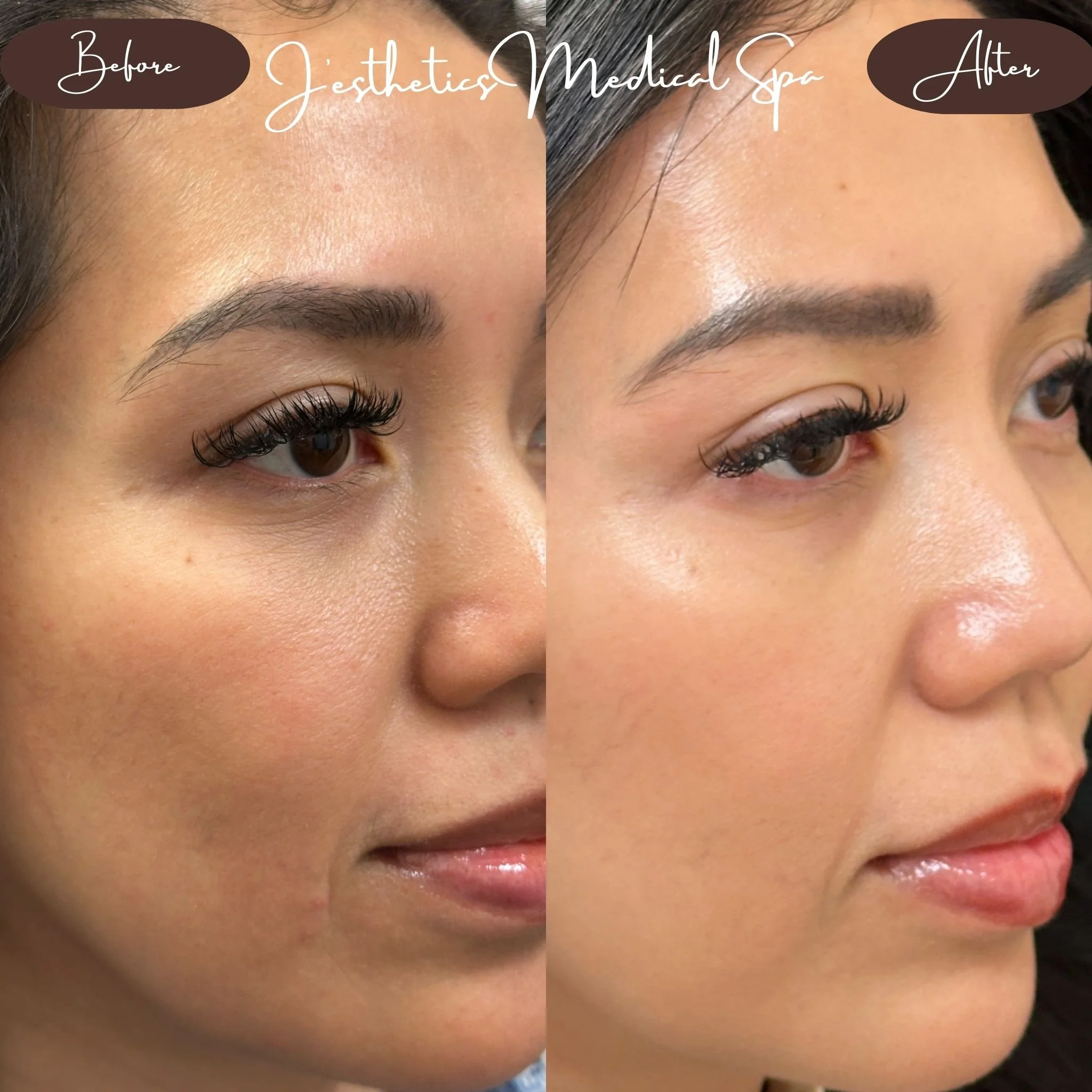 Chemical Peel After