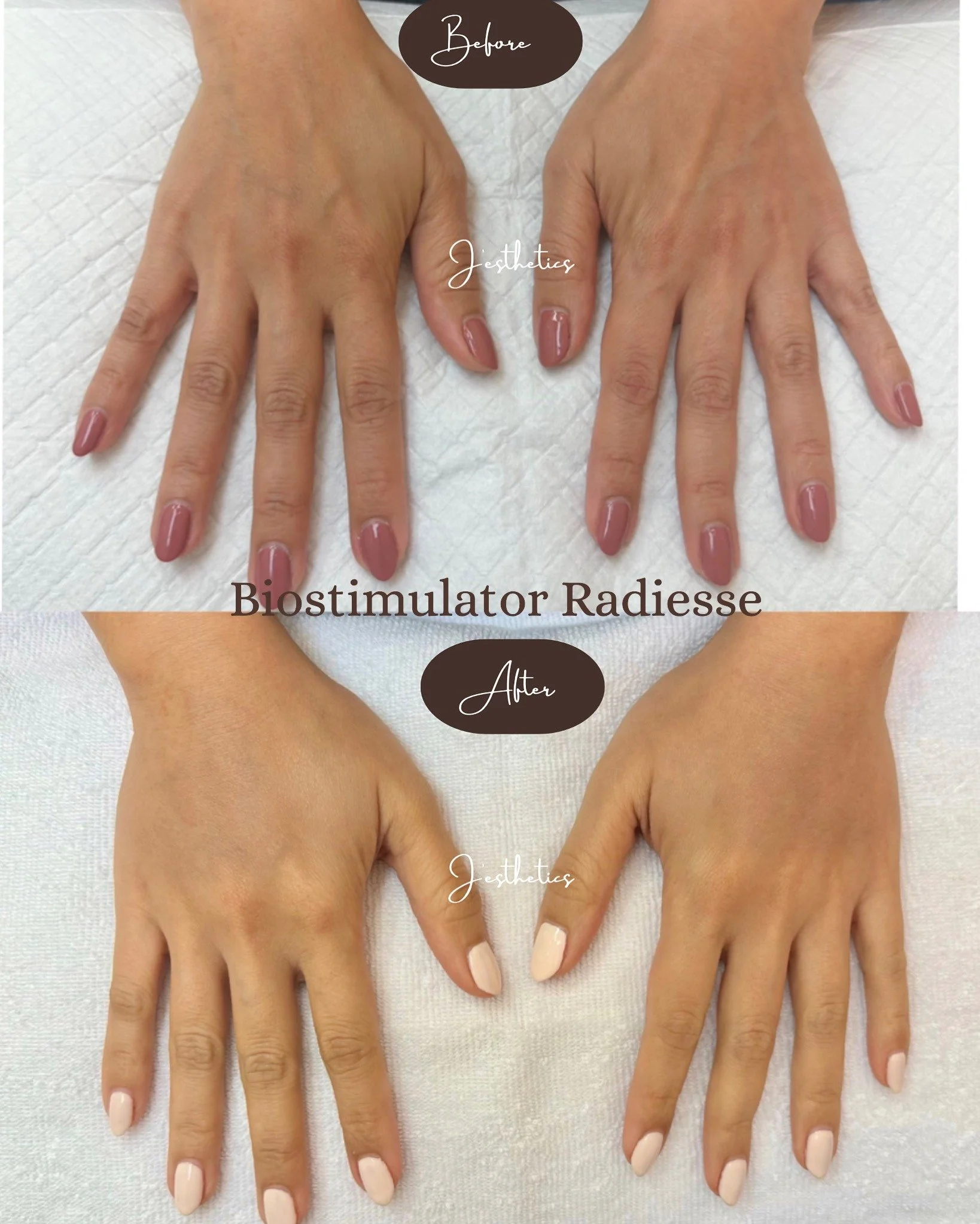 Laser Resurfacing After