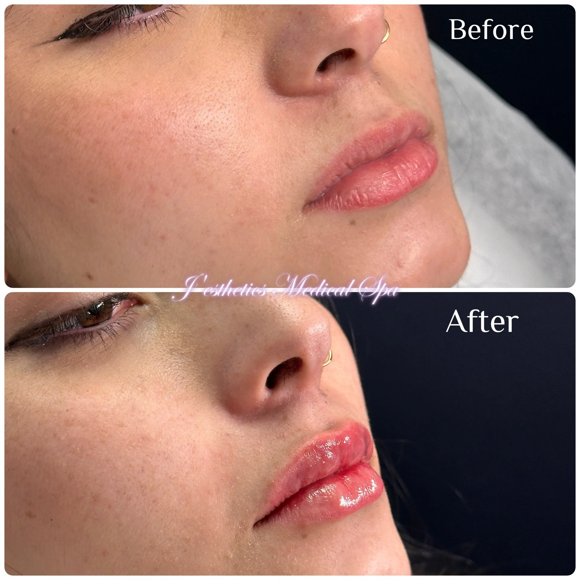 Lip Filler Before