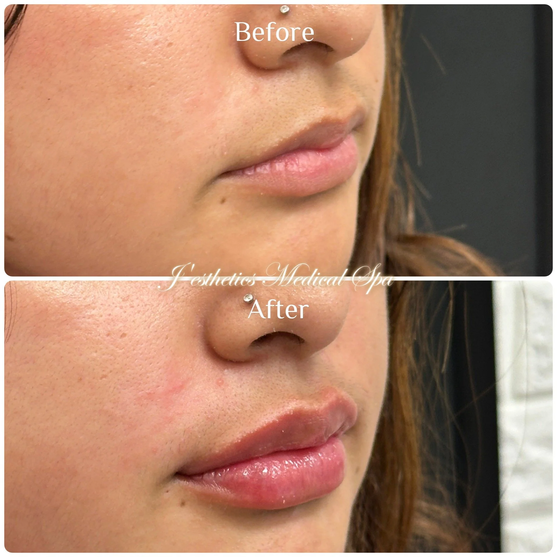 8D Lip Enhancement Before