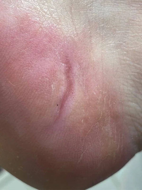 Smoother heel after Deep Foot Treatment